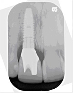 Dental NC Implants Denver