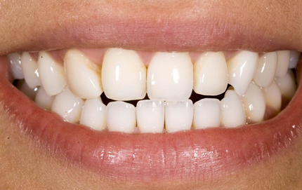 Denver NC Porcelain Veneers Dentist