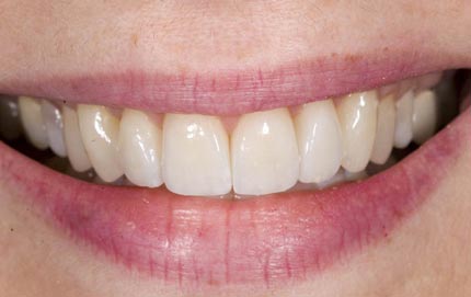 Denver NC Veneers Dentist