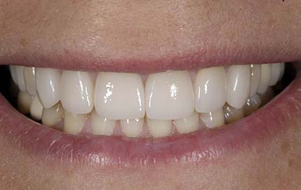 Denver NC Veneers Dentist