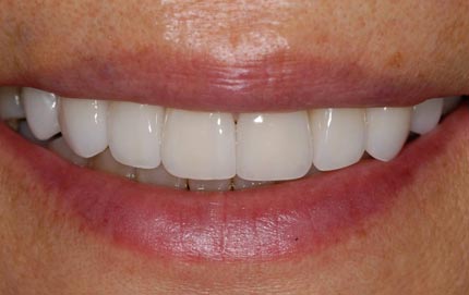 Denver NC Veneers Dentist